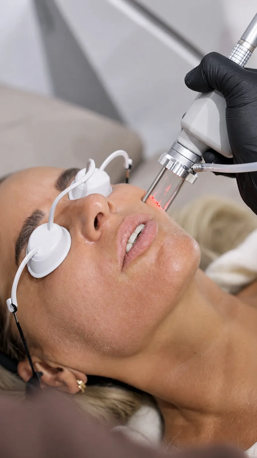 Eine Laserbehandlung im Gesicht, Standbild aus einem Klinikvideo, das als Anzeige verwendet wird